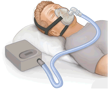 Nasal steroid spray for sleep apnea